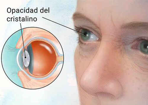 Imagen de ¿Que es la Catarata?